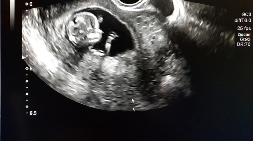 Tepki çeken kürtaj tasarısı: Zorla izlettirecekler!