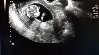 Tepki çeken kürtaj tasarısı: Zorla izlettirecekler!