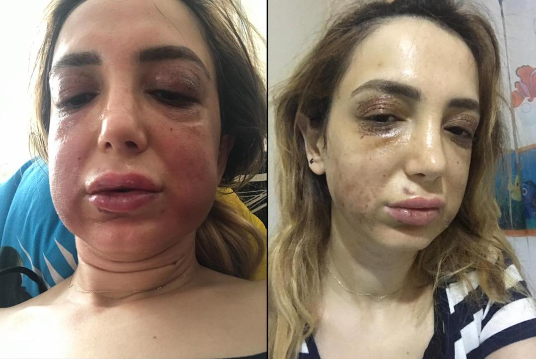 Estetik y&uuml;z&uuml;nden tanınmaz hale geldi!