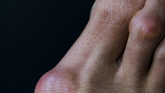 Rahat olduğu için tercih ediyoruz ama babet ayakkabılar ayak sağlığını bozuyor