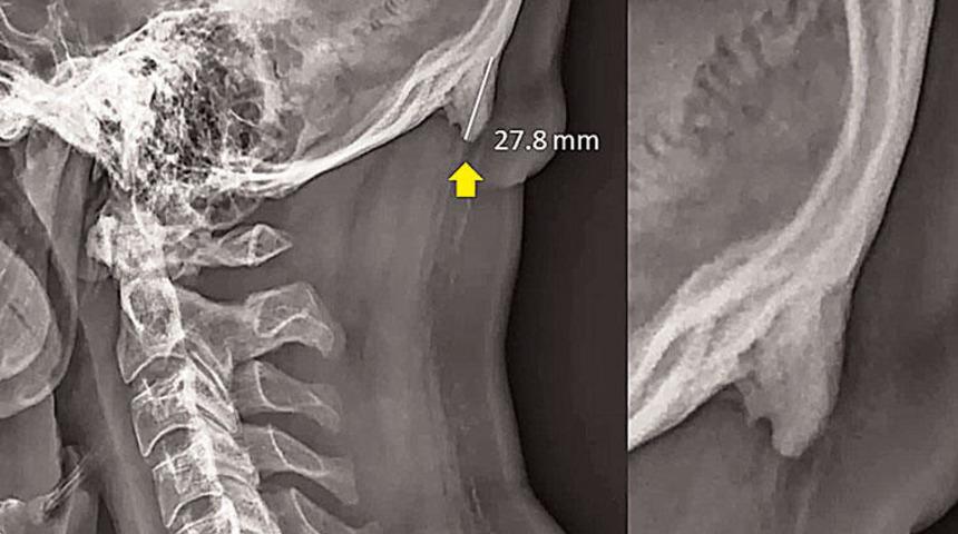 Telefona bakmaktan ensemizde boynuz çıkıyor