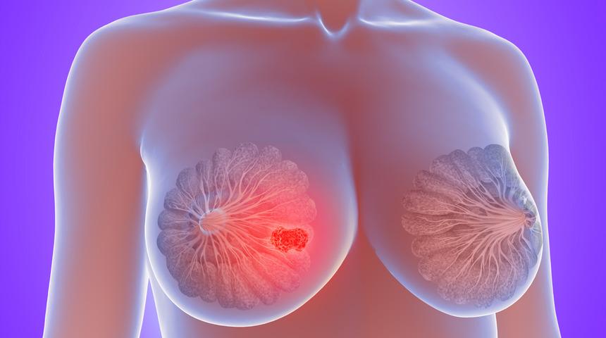 Meme kanserleri dondurularak tedavi edilebilecek