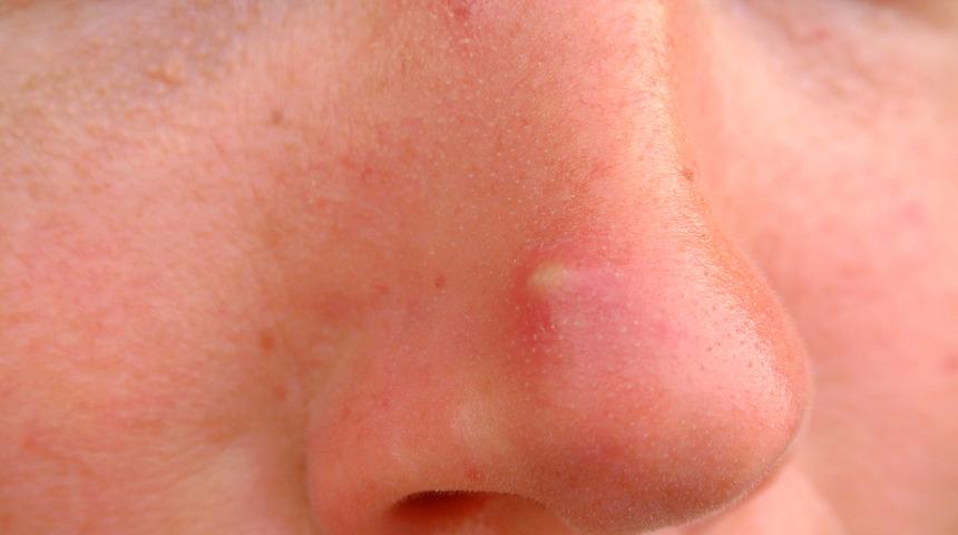   Sivilcem var diye üzülmeyin! Çalışmaya göre, sivilcesi olan kişiler daha geç yaşlanıyor