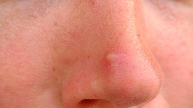   Sivilcem var diye üzülmeyin! Çalışmaya göre, sivilcesi olan kişiler daha geç yaşlanıyor