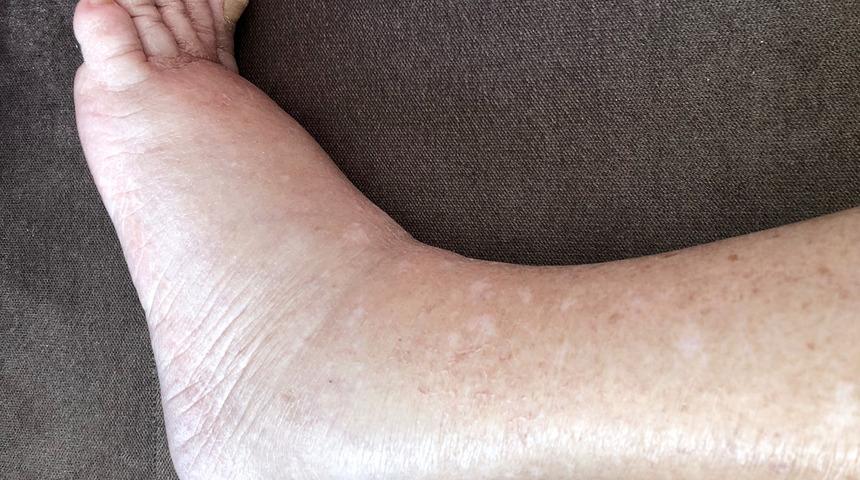 Çok fazla tuz tükettiğinizin 7 işareti