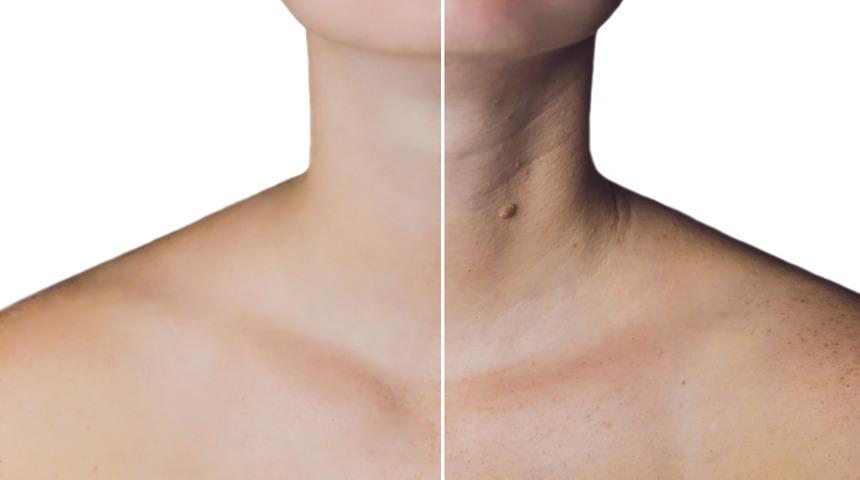 Boyun germe estetiği ile yıllara meydan okuyun 