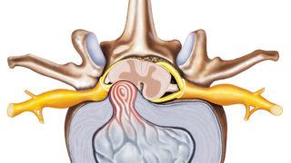 Bu belirtiler ameliyat gerektiriyor! İşte bel fıtığında operasyon kararı verdiren durumlar