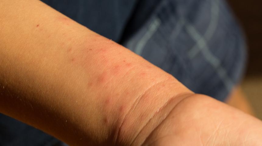 Çocuklarda en sık görülen yaz alerjileri