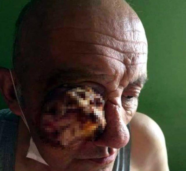 Göz tümörüne yakalanan orman işçisinin yardım feryadı