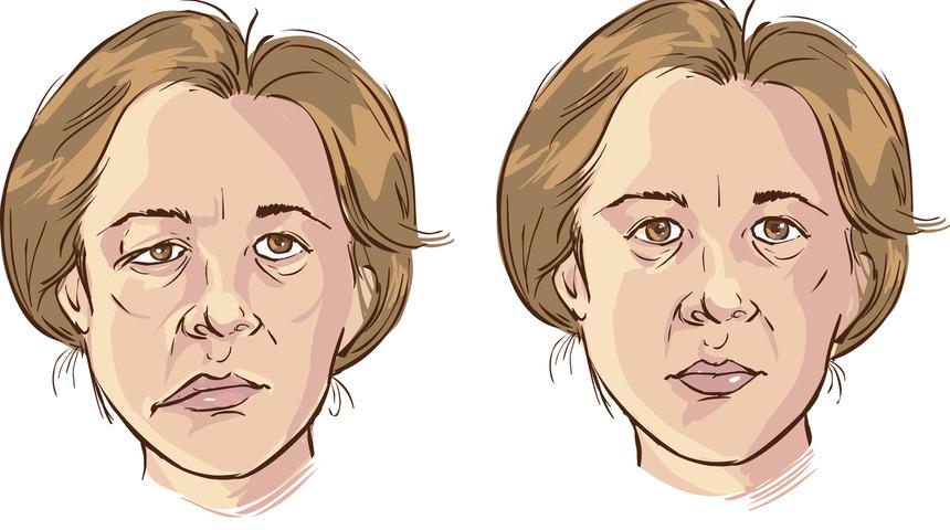 Yüz felci nedir? Klima yüz felcini tetikler mi?