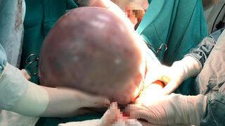 Karnından 10 kiloluk kist çıktı