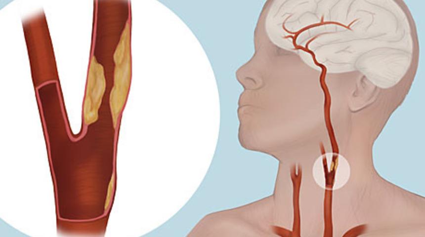 Sinsi tehlike: Karotis darlığı