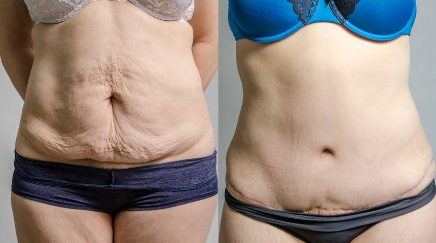 Vücut kitle indeksi nasıl hesaplanır? Karın germe estetiği Abdominoplasti hakkında bilmeniz gerekenler