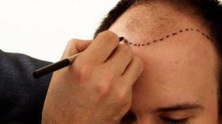 Türkiye dünyada ilk 5'te! Saç ekonomisi 1 milyar doları geçti