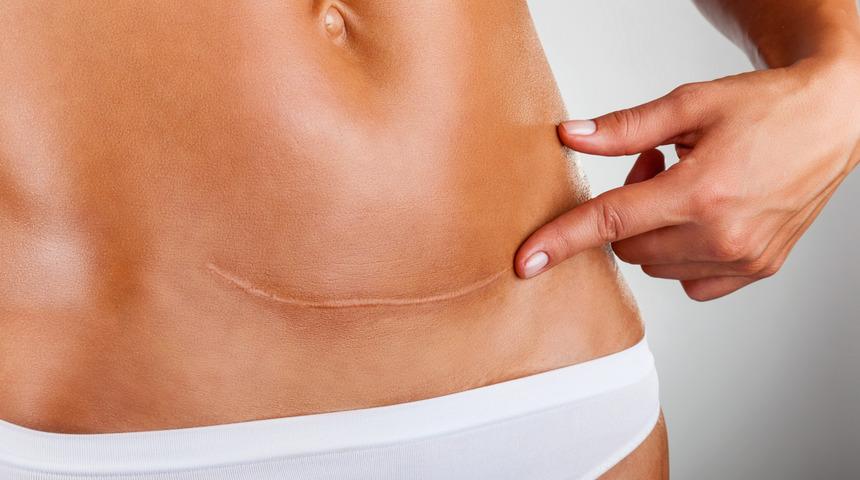 Tampon yerine ped kullanın! İşte sezaryen doğum sonrası bilmeniz gerekenler