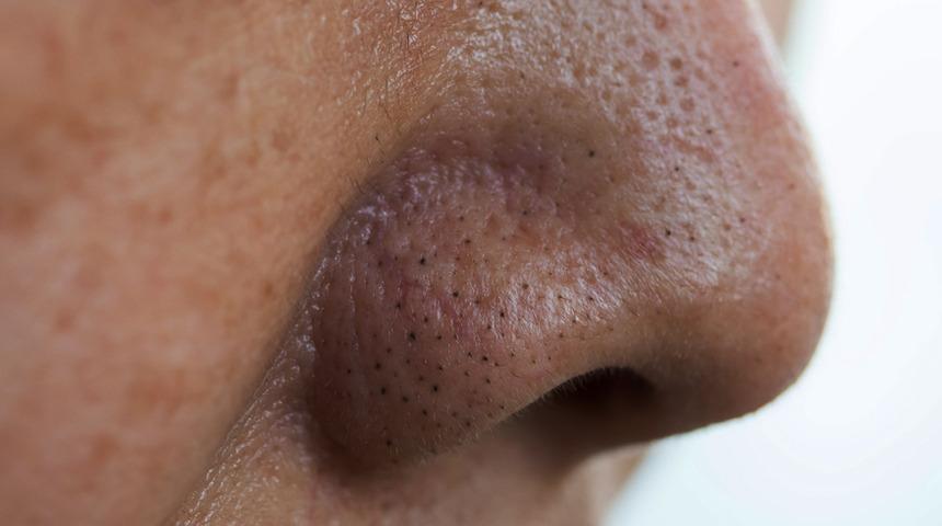 Aknelerinizin nedeni, bağırsaklarınızın sağlıksız olması olabilir