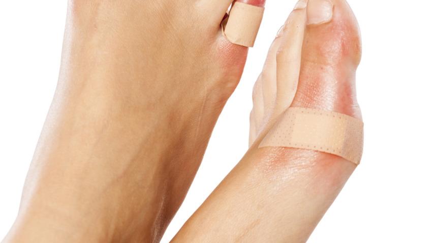 Uzmanından uyarı: Nasırı kesinlikle yakmayın