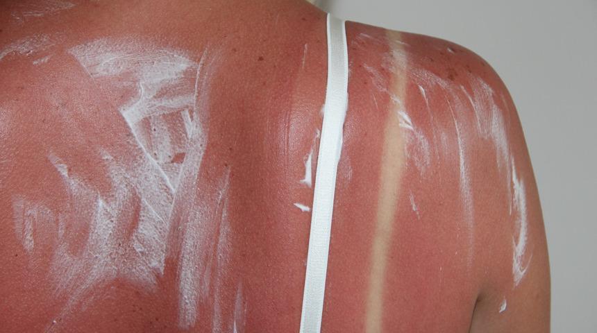 'Sağlıklı bronzlaşma' diye bir şey yok! Güneş yanığı öyküsü deri kanserine yol açıyor