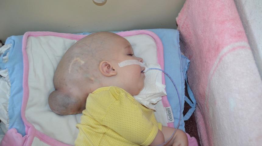 12 aylık bebeği görenler şoke oluyor! Beyni kafatasının dışında büyüyor