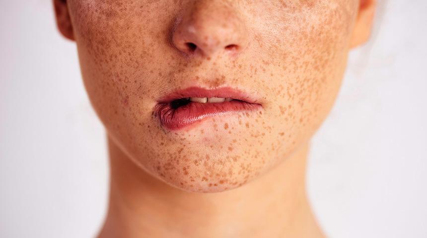 Yaz aylarında &ccedil;illerin artışını nasıl &ouml;nlersiniz?