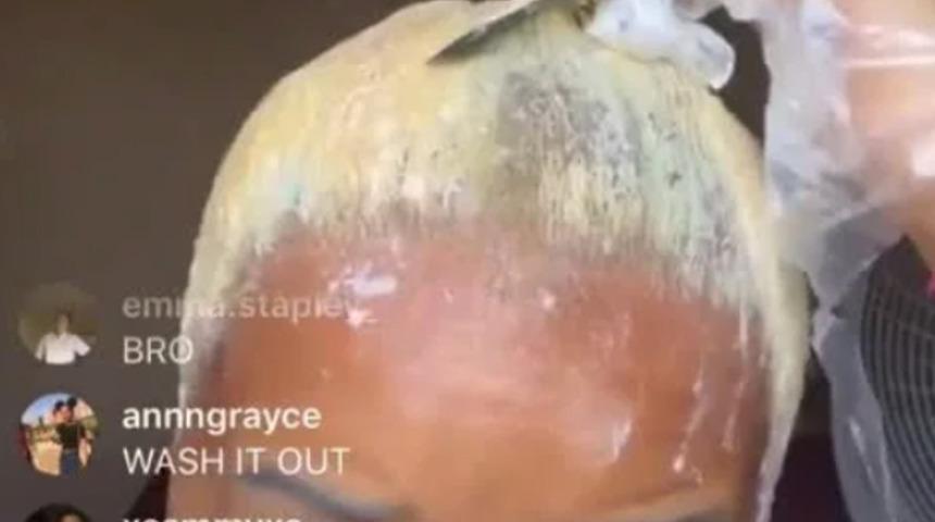  Kimyasalın bedeli ağır oldu! G&uuml;zellik Blogger'ı g&uuml;zelleşeyim derken kel kaldı