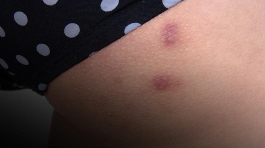 Kal&ccedil;anızdaki sivilceye pantolonlarınız neden olabilir! Peki nasıl kurtulacaksınız?