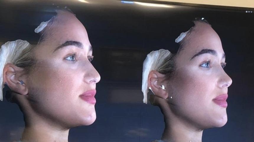 Op. Dr. Volkan Kahya: &ldquo;Burun Estetiği &ouml;ncesi burnum nasıl olacak diye &uuml;z&uuml;lmeyin&rdquo;