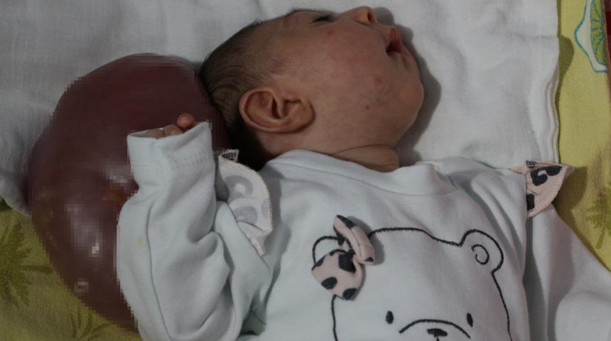 Doktorların 'ölür' dediği iki kafalı bebek için çare arıyorlar