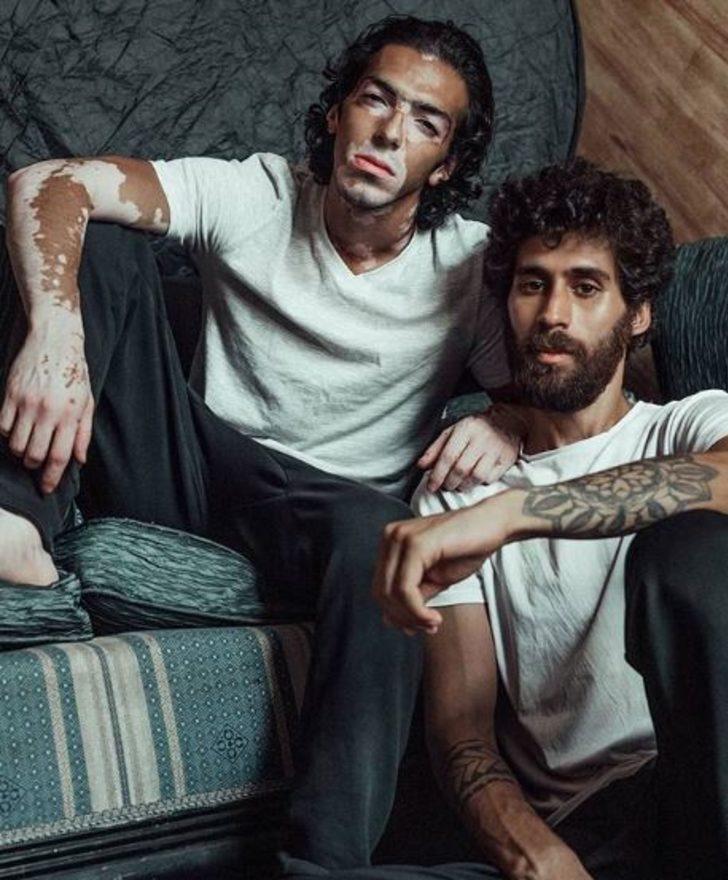 Winnie Harlow'dan sonra erkek vitiligo model! G2
