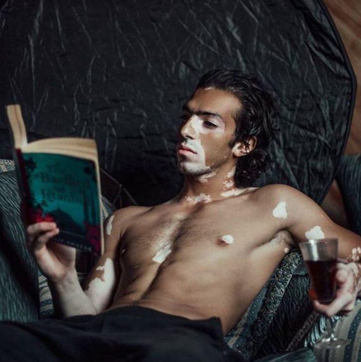 Winnie Harlow'dan sonra erkek vitiligo model! G3