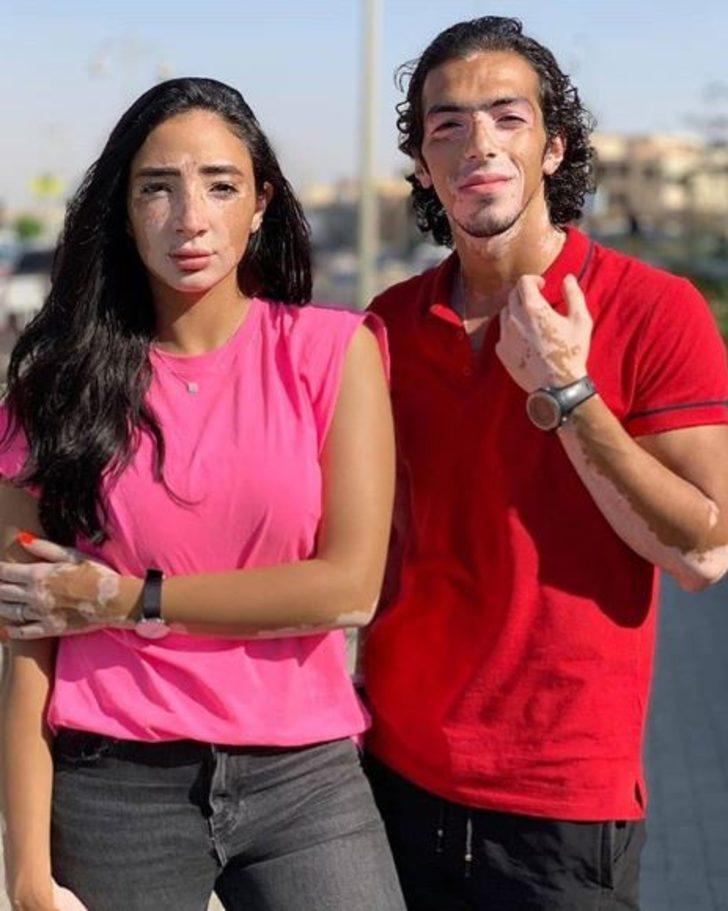 Winnie Harlow'dan sonra erkek vitiligo model! G4