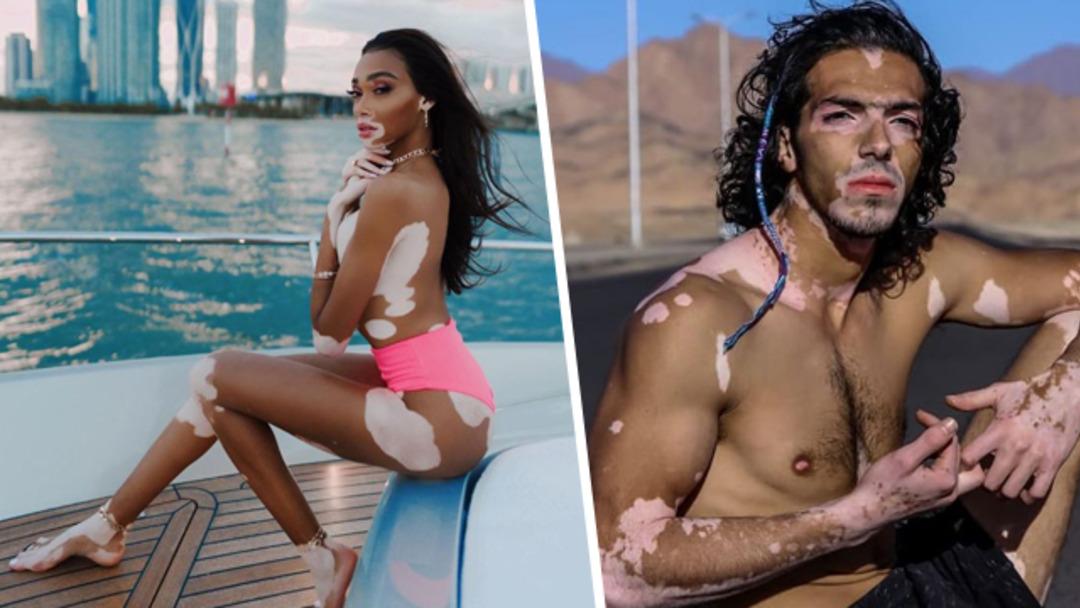 Winnie Harlow'dan sonra erkek vitiligo model!