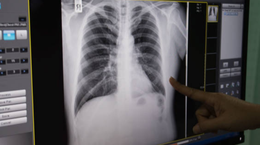 KOAH g&ouml;r&uuml;lme sıklığı kadınlarda artıyor