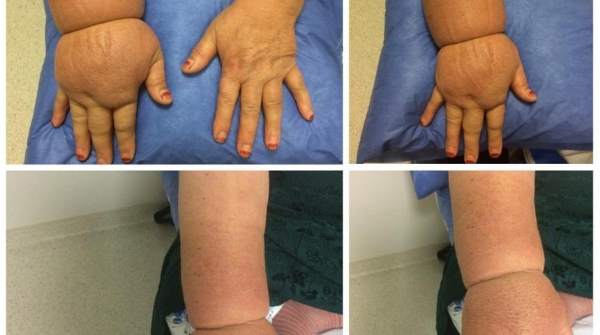 Lenfodem hastalarına ameliyatsız tedavi