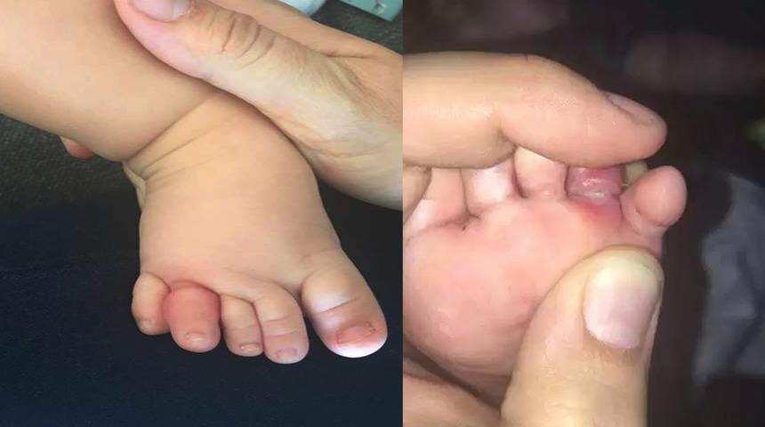 Turnike sendromuna dikkat! Annesinin saçı az daha parmağından edecekti