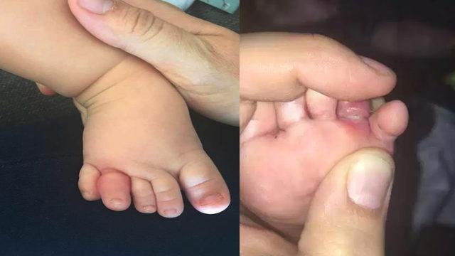 Turnike sendromuna dikkat! Annesinin saçı az daha parmağından edecekti