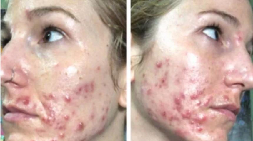 Sivilceleri yüzünden depresyona girdi şimdi tüm kadınları 'gerçek' yüzlerini göstermeye davet ediyor