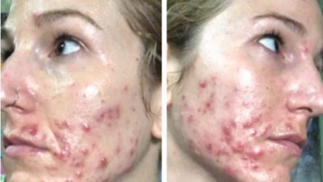 Sivilceleri yüzünden depresyona girdi şimdi tüm kadınları 'gerçek' yüzlerini göstermeye davet ediyor