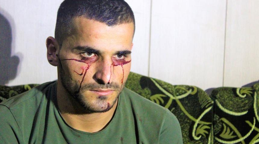 'Kan ağlayan' Iraklı gen&ccedil; hastalığına &ccedil;are arıyor