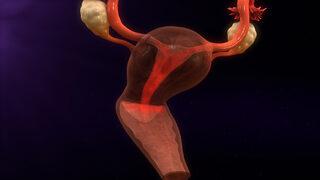 Endometriozis semptomları hakkında bilmeniz gerekenler 