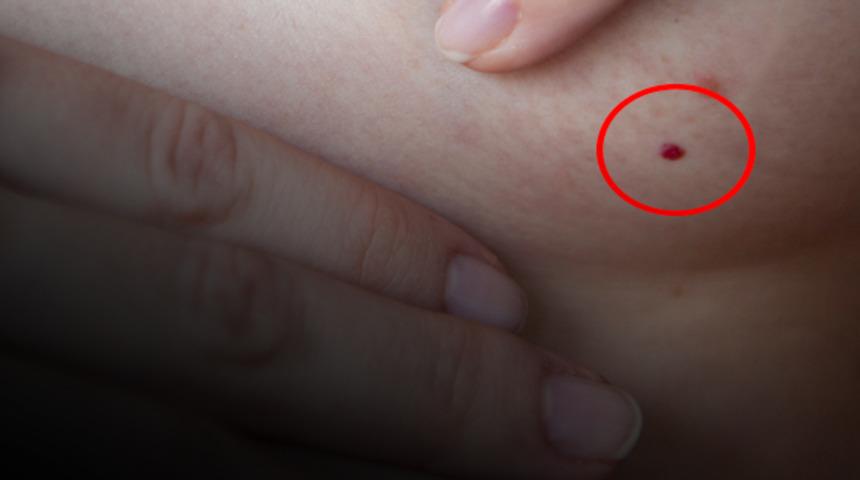 Vücuttaki kırmızı lekeler ne anlama geliyor?
