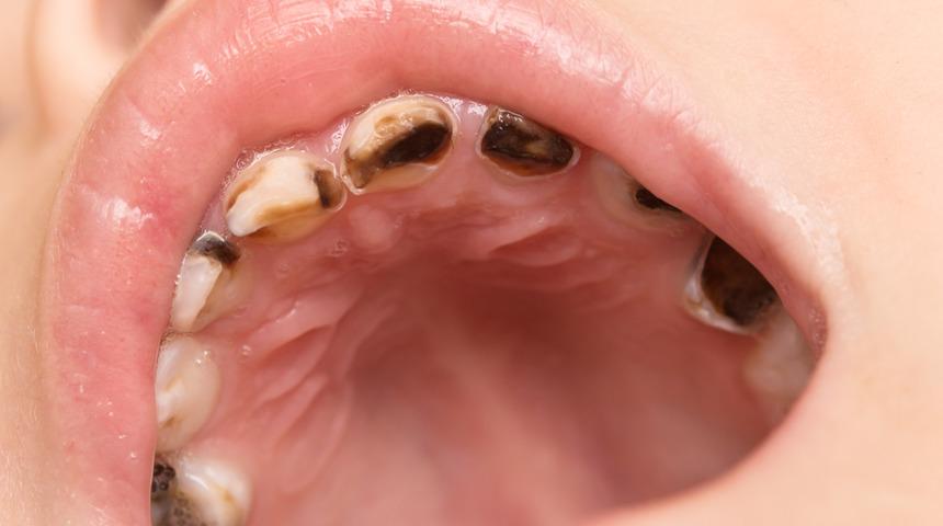 Bebeklerde diş yapısını bozan biberon çürüklerine karşı ne yapılmalı?