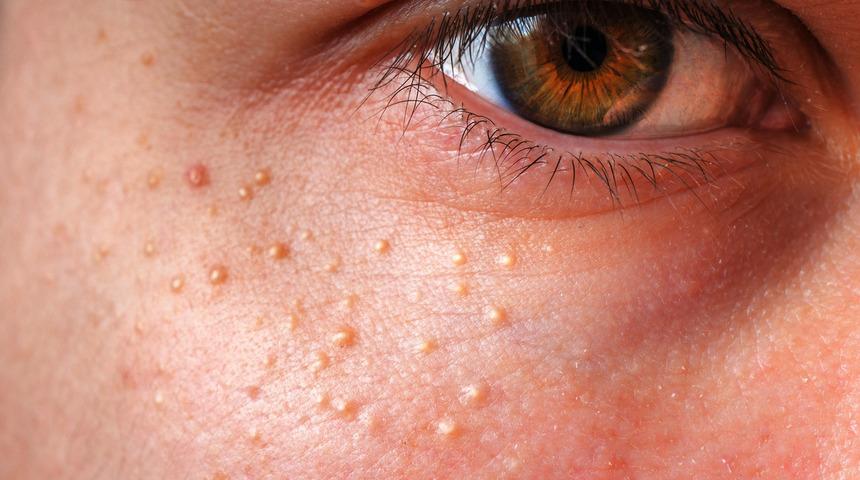 Y&uuml;z&uuml;n&uuml;zdeki beyaz bezelerden kurtulmanın evdeki &ccedil;&ouml;z&uuml;m&uuml;