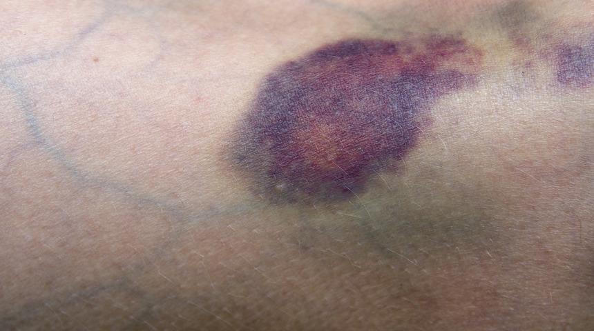 Güzelliğinize gölge düşmesin vücudunuzdaki morluklardan bu önerilerle kurtulun