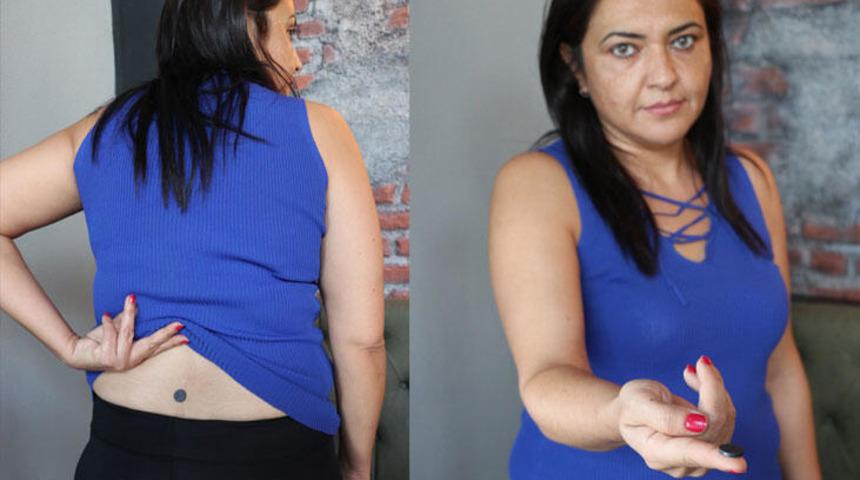 6 yıl önce belinde unuttular! Mıktanısla buldu