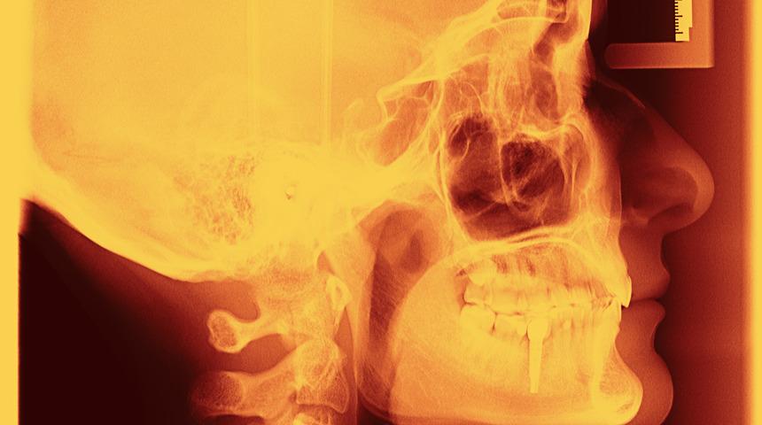 K&ouml;r hastalar g&ouml;r&uuml;şlerini kısmen yeniden kazanabildi