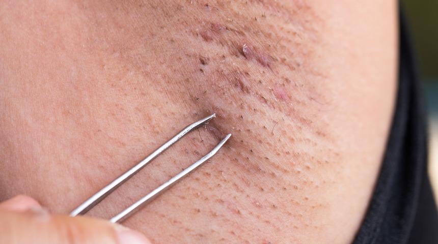 Koltuk altı tüylerinden hızlıca kurtulmak ister misiniz? Tahriş yapmayan zerdeçal yöntemini deneyin