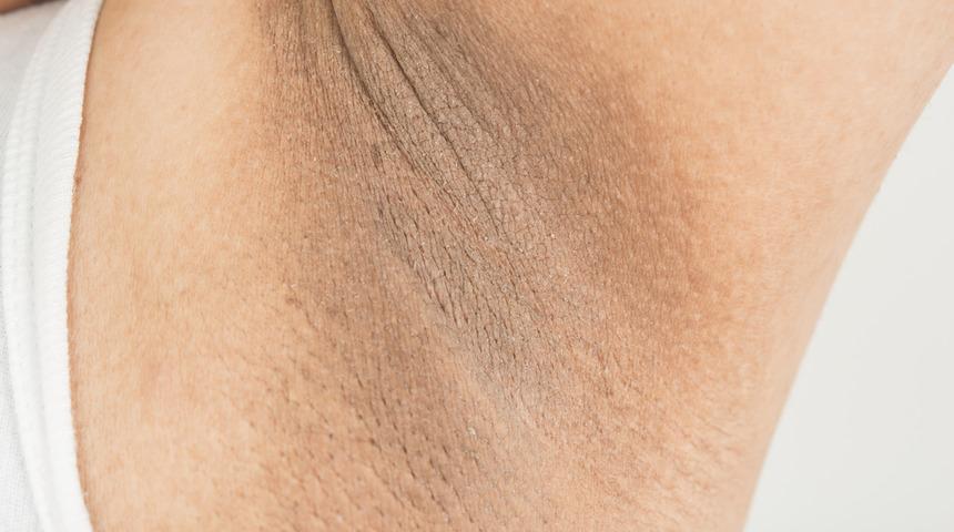 Hepimizin sorunu! Koltuk altı neden kararıyor? 