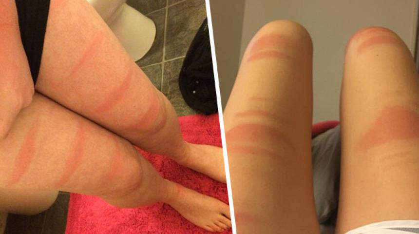 Yaz aylarında yırtık kot giyerek hayatlarının hatasını yaptı!