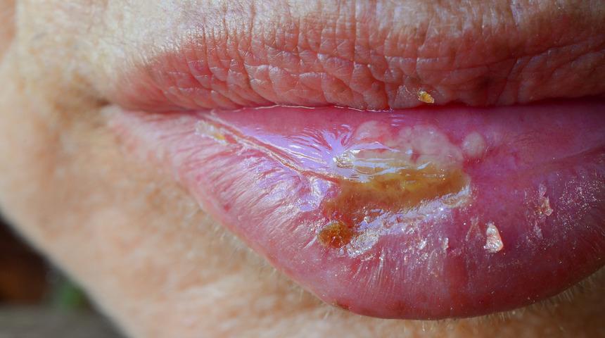 Uçuk virüsü kanserle ilişkilendiriliyor, peki ne kadar doğru?